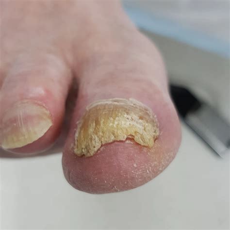 thick toenails symptoms